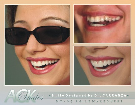 Porcelain Veneers